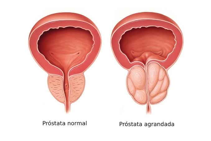 Enfermedades de la Próstata: Guía Completa para el Paciente